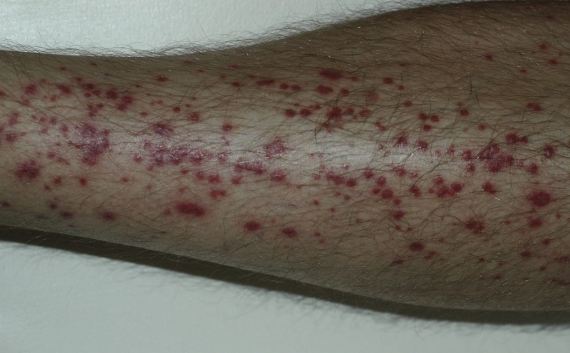 Purpura sur mollet purpura mollet agave oxalate